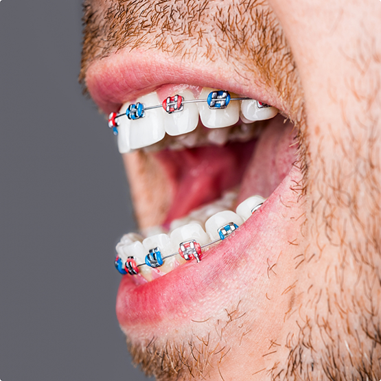Close up of a man with braces