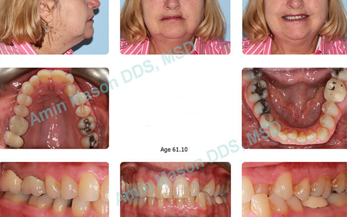 Woman with misaligned teeth before braces treatment