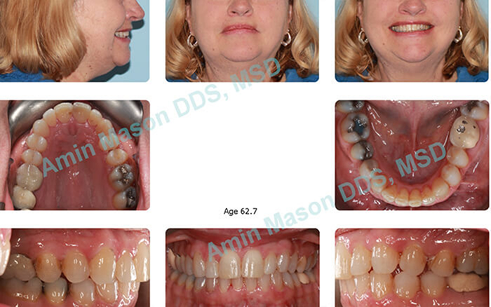 Woman with straightened teeth after braces treatment