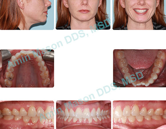 Woman with crowded teeth