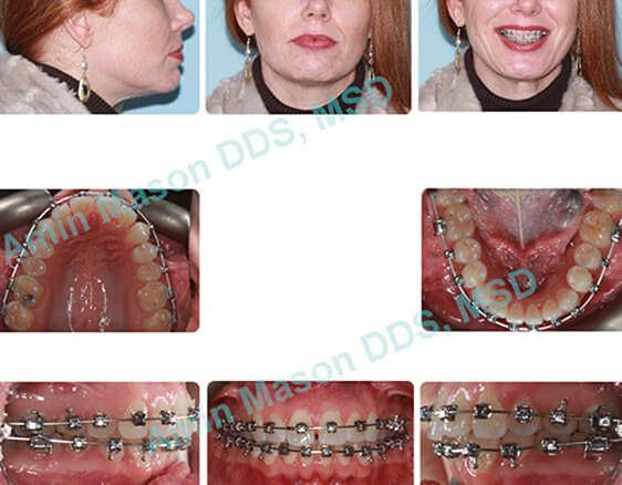 Woman getting her crowded teeth treated with braces
