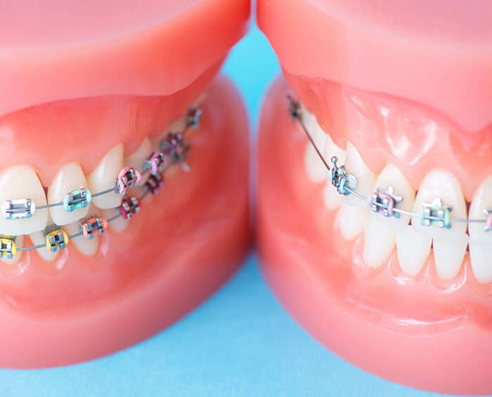 Two models of the teeth with braces in Columbus