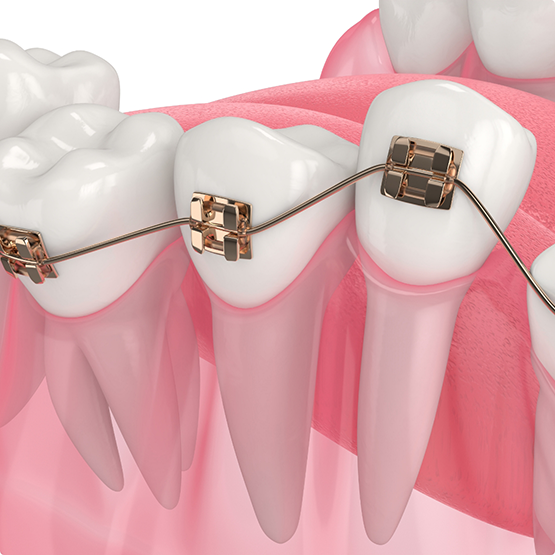Illustration of a row of crooked teeth with braces