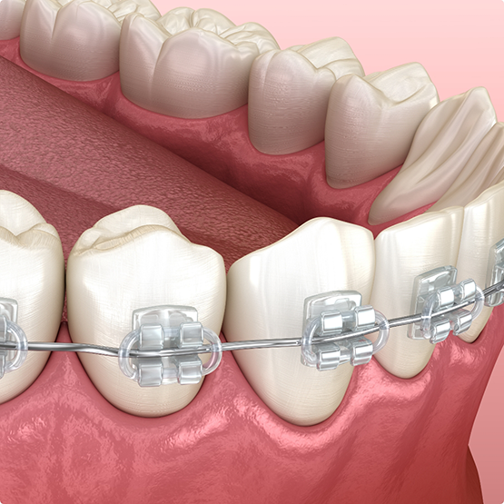 Illustration of teeth with braces with clear brackets