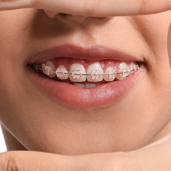 Smile with traditional braces