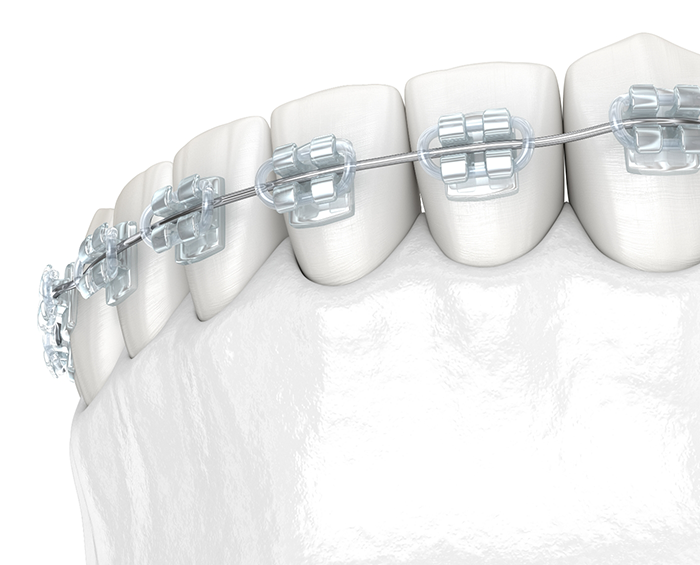 Illustrated row of teeth with clear braces in Columbus