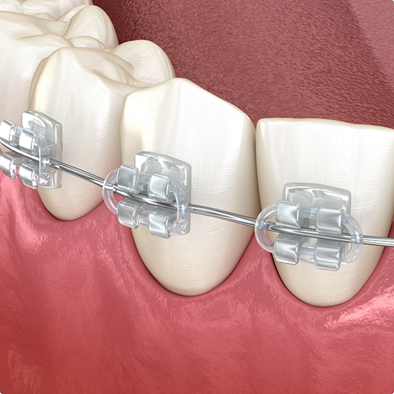 Illustrated teeth with clear braces