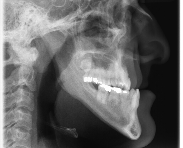 X-ray of a profile of a person with a severe underbite