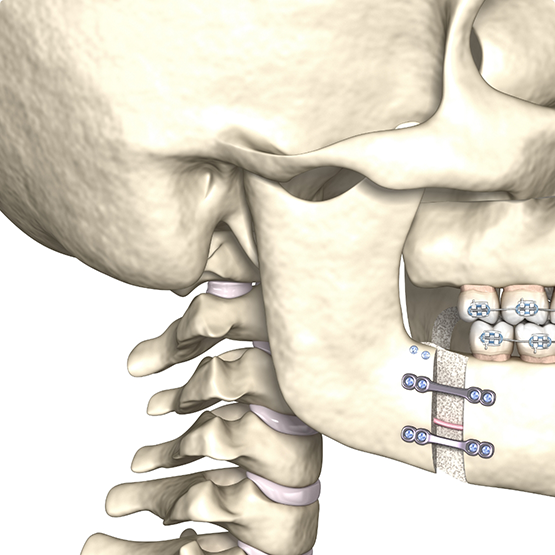 Illustration of a skull with orthodontic attachments in the jawbone and braces on the teeth