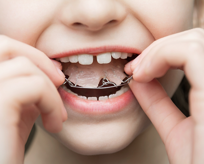 Close up of a child placing a metal retainer in their mouth
