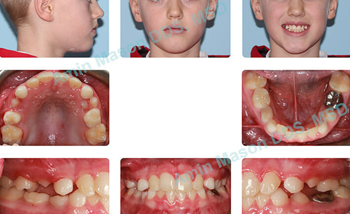 Collage of a young boy with more aligned teeth and jaws