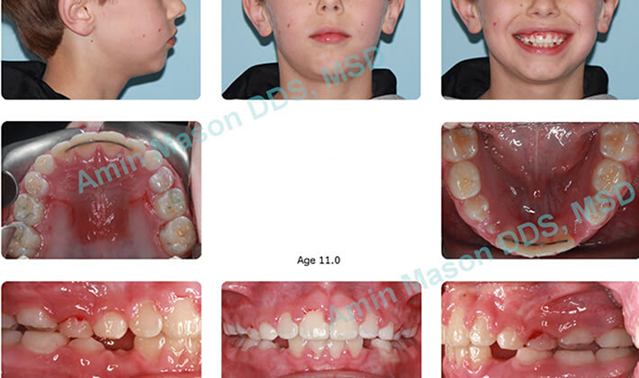 Collage of a young boy after treating an open bite