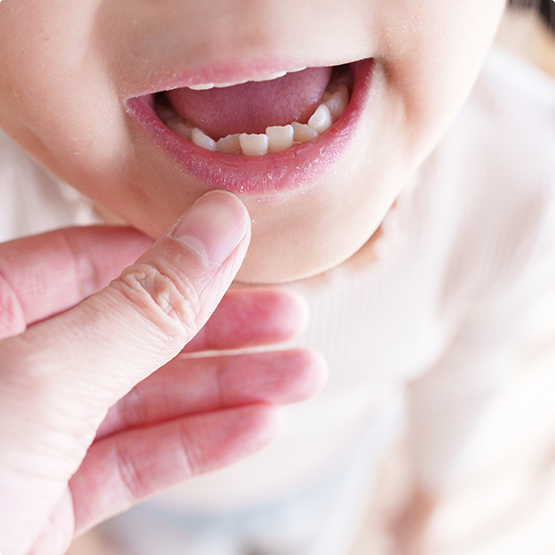 Child with crooked lower teeth