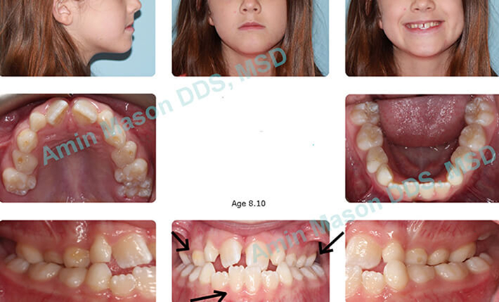 Collage of a young girl with misaligned teeth