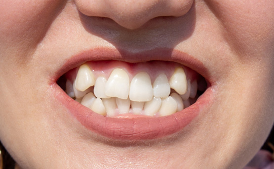 Close-up of person’s smile with crowded, overlapping teeth