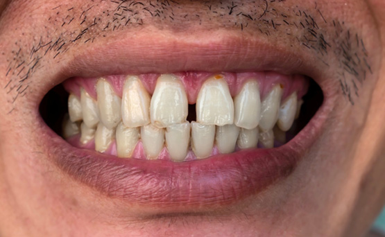 Close-up of man’s smile with gap between the two front teeth