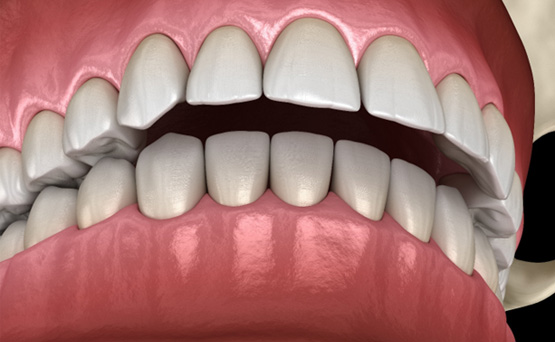 Illustration of an overbite viewed from downward angle