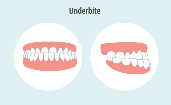 Illustration of an underbite viewed from front and side