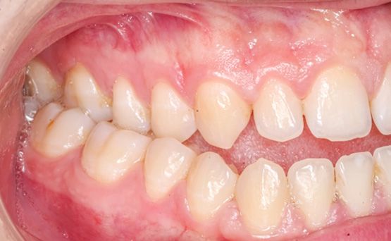 Close-up of person’s open bite