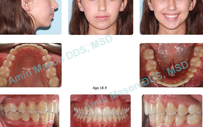 Young blonde woman holding Invisalign