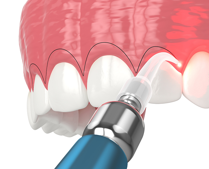 Illustration of a laser correcting an uneven gumline