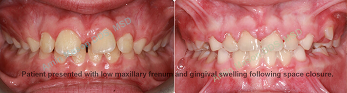 Mouth before and after correcting gapped teeth