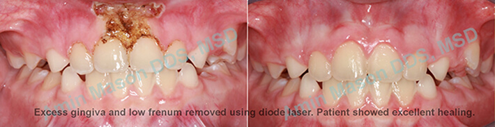 Mouth before and after removing excess gum tissue