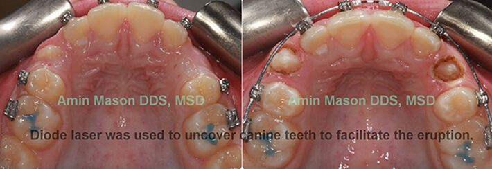 Mouth before and after uncovering a tooth stuck under the gums