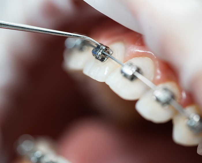 Close up of an orthodontist adjusting braces