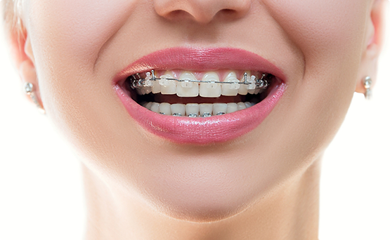 Woman's mouth with braces without brackets on multiple upper front teeth