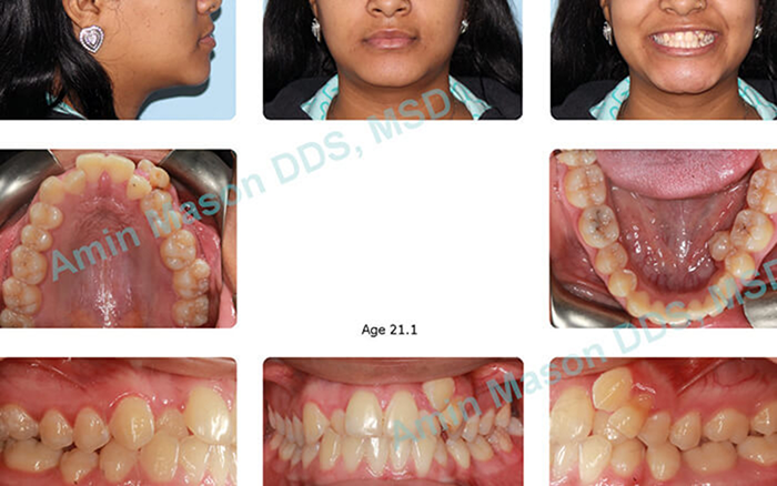 Collage of a patient with crooked and crowded teeth