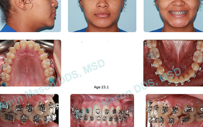 Collage of a patient with Damon braces on their teeth