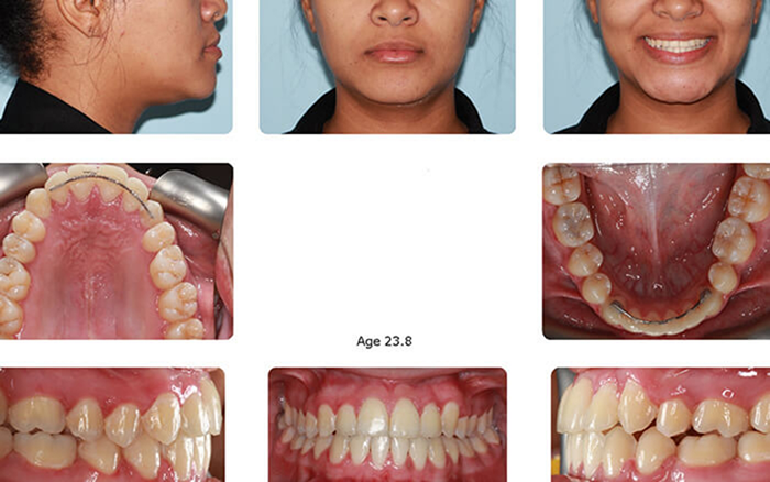 Collage of a patient with straighter teeth after Damon treatment