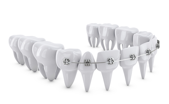 Illustration of a row of teeth with Damon self-ligating braces