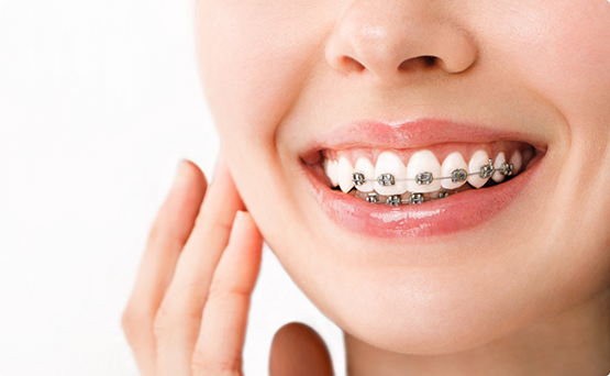 Close up of a smile with braces on the teeth
