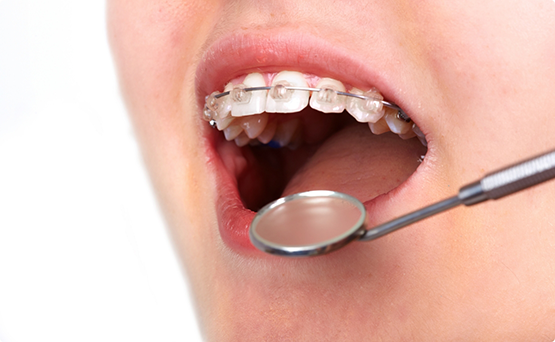 Mouth with braces next to a dental mirror