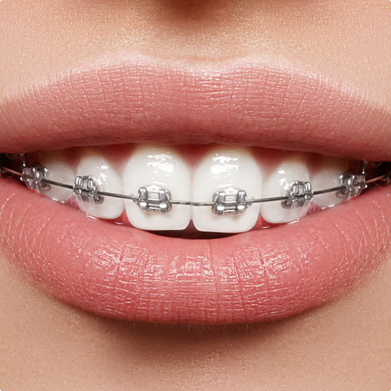 Close up of a mouth with braces