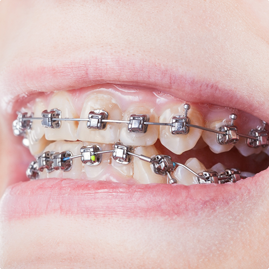 Mouth with braces over the crooked teeth