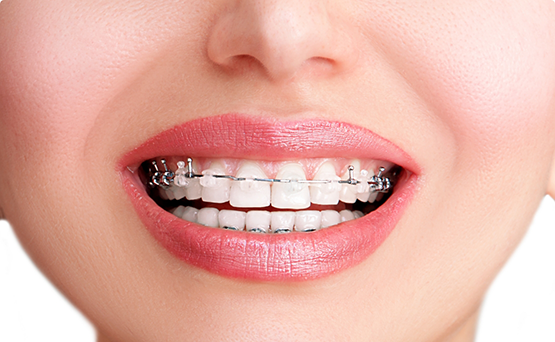 Mouth with braces with different brackets on the front and back teeth