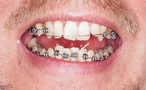 Man's mouth with braces without brackets on several upper front teeth