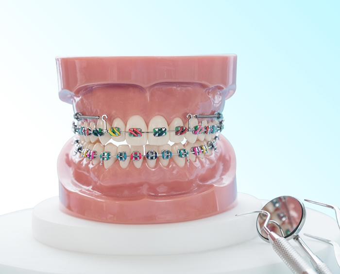 Model of the teeth with traditional braces in Columbus