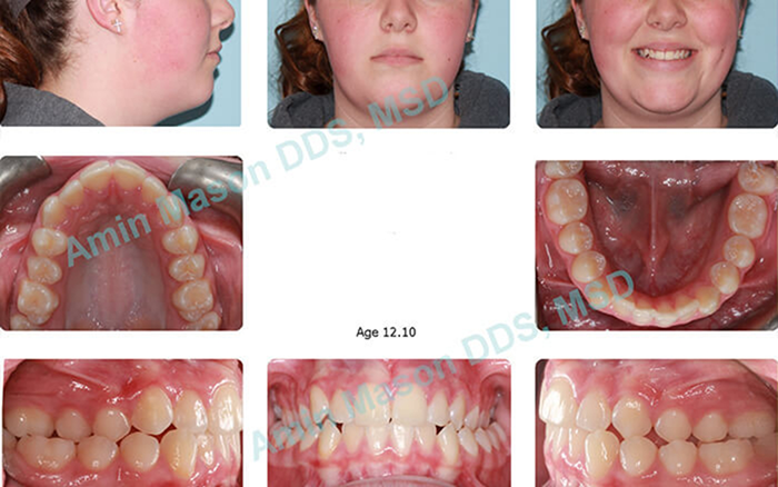 Collage of a woman with misaligned teeth before braces