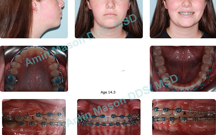 Collage of a woman during braces treatment