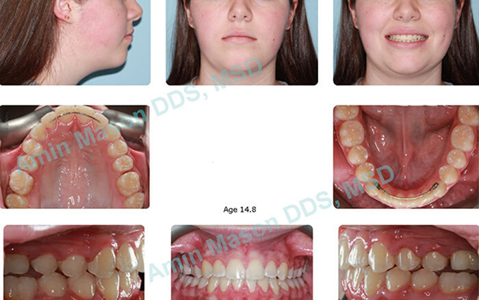 Collage of a woman with straight teeth after braces treatment