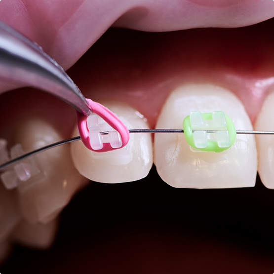 Close up of tweezers placing an elastic band over a braces bracket