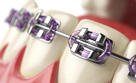 Illustration of a row of teeth with braces