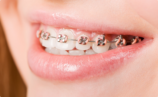 Close up of a smile with braces