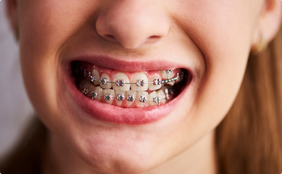 Close up of a person with braces grinning