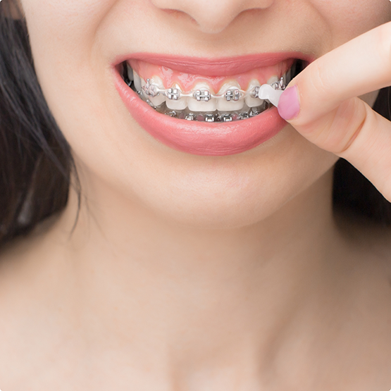 Young woman placing an elastic band over her braces