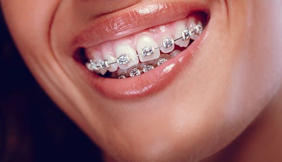 Close up of a person with braces smiling